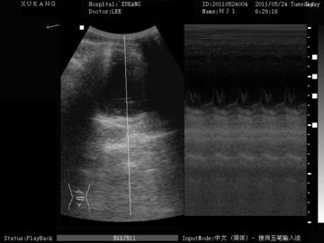 Full Digital Mobile Ultrasound Machine Medical Trolley Ultrasound Scanner ATNl51353 Plus 80 Elements supplier